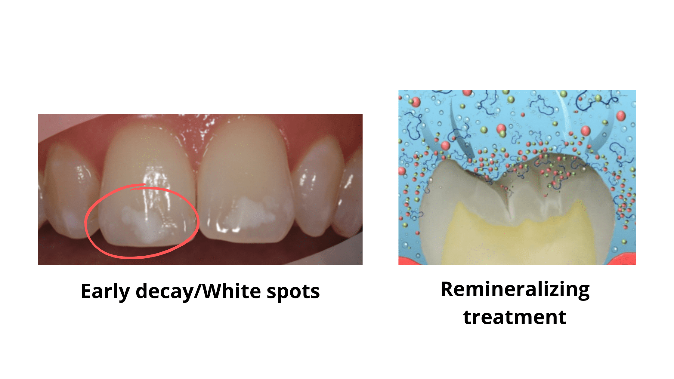 White spots on front teeth and remineralization treatment