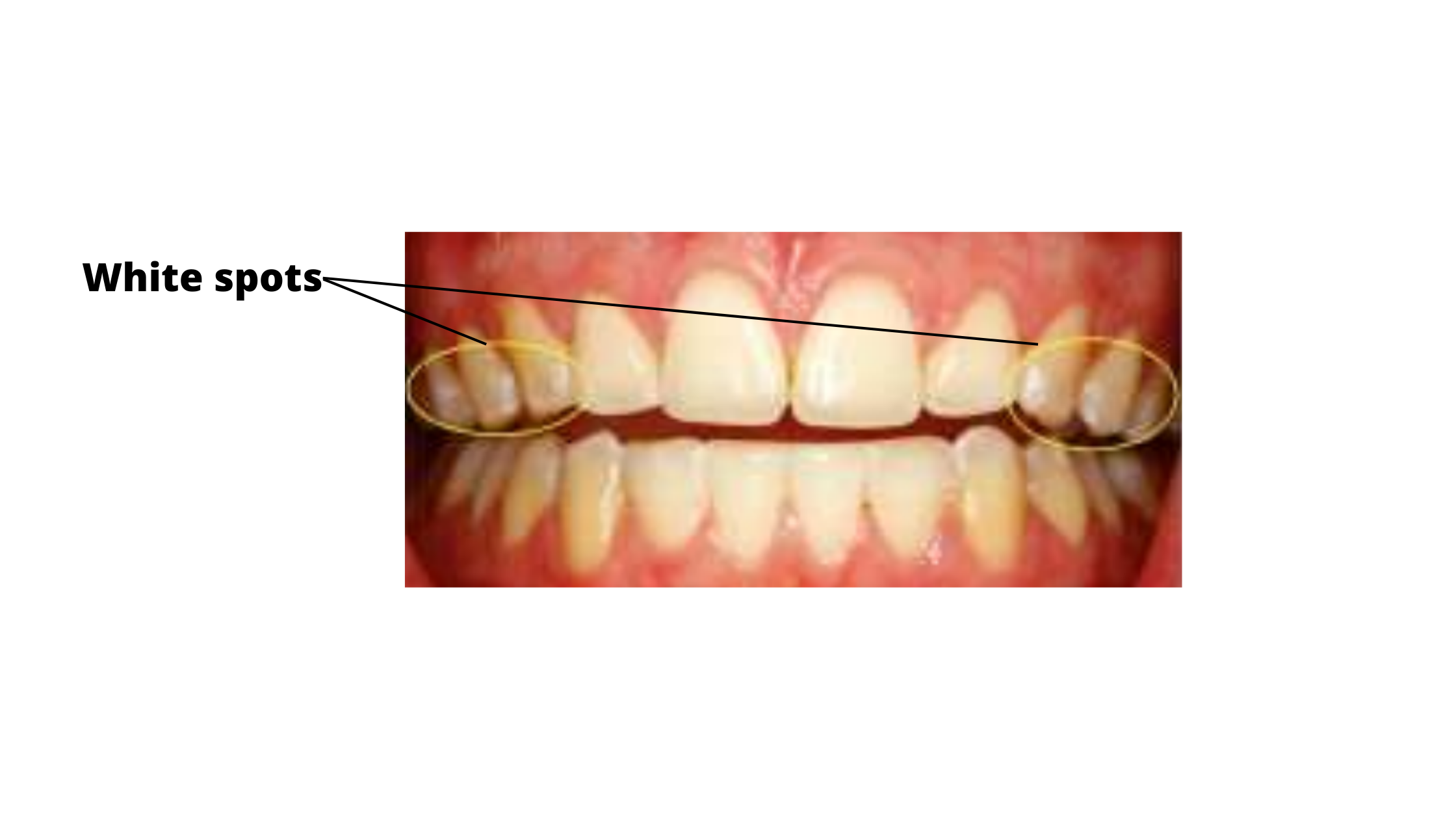 white spot lesions on front teeth