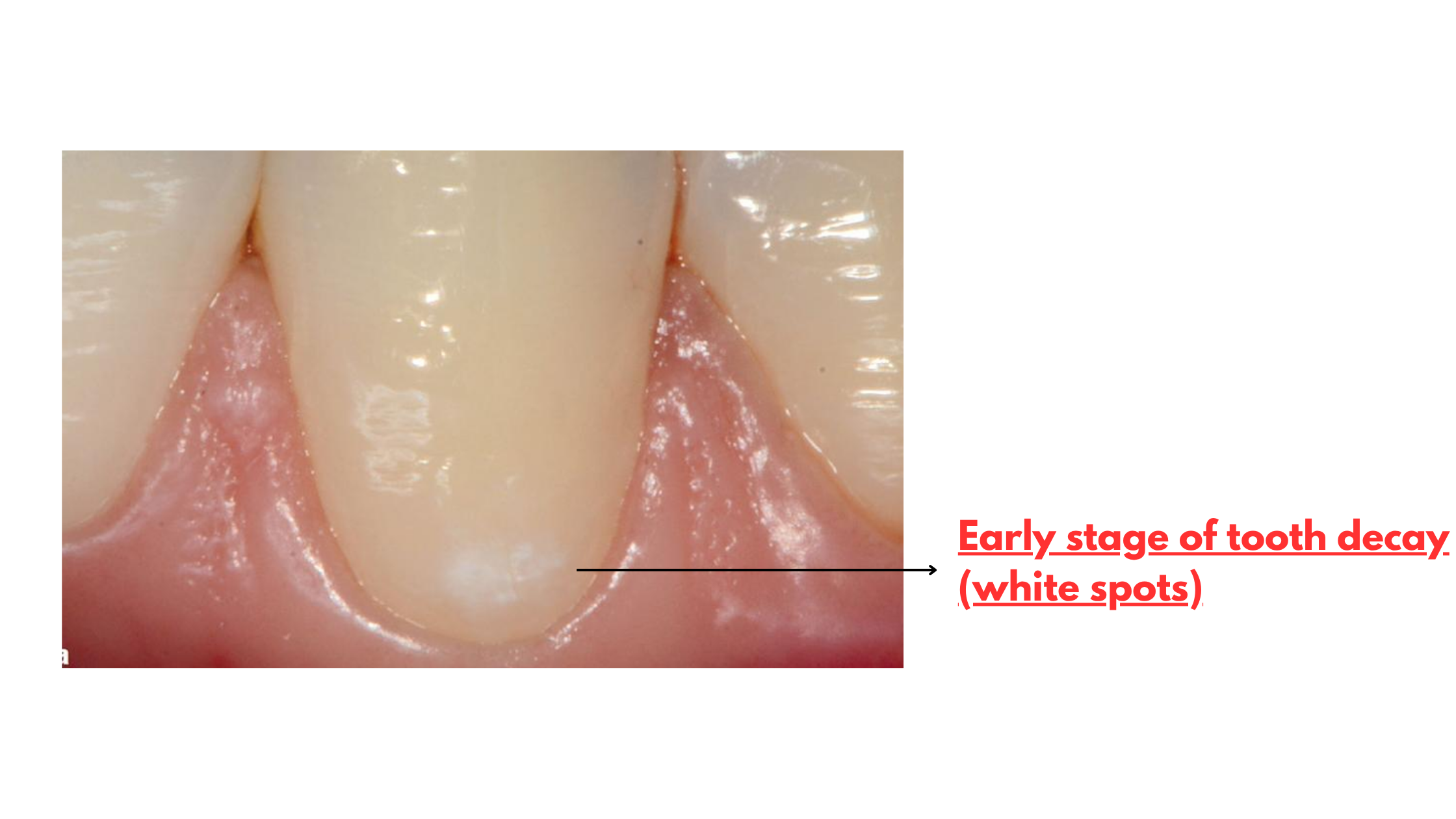 white spot lesions on front teeth