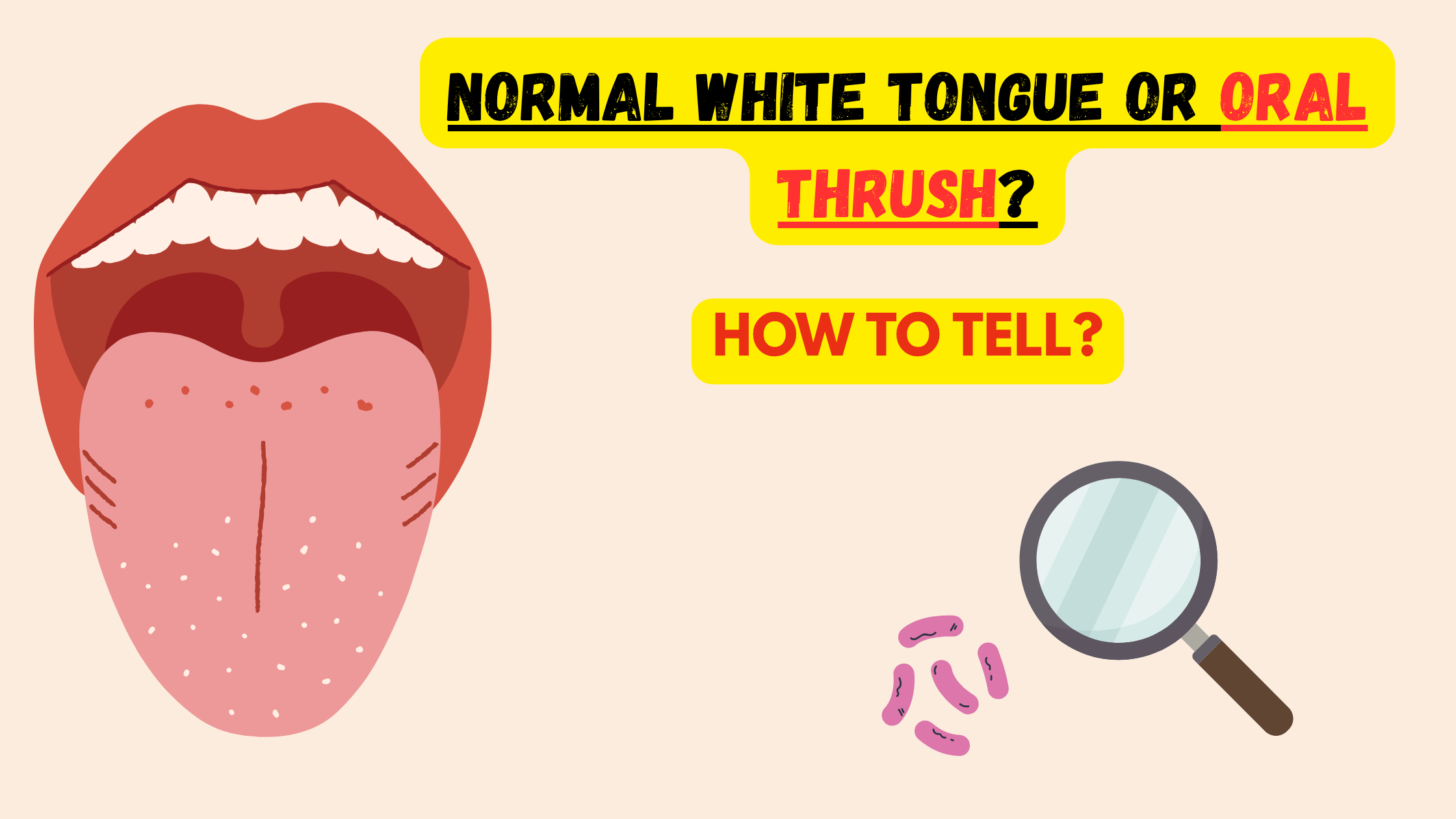 Oral thrush vs harmless white tongue
