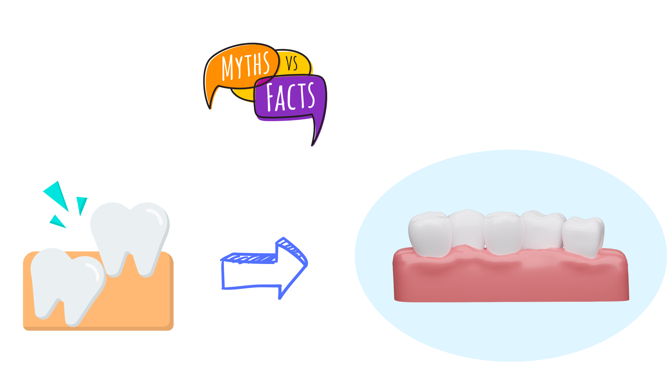 Wisdom teeth as the cause of crowded front teeth: Myth vs. reality