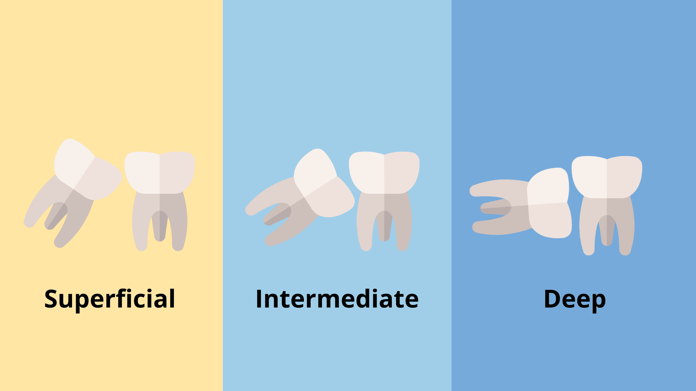 impaction depth of wisdom teeth