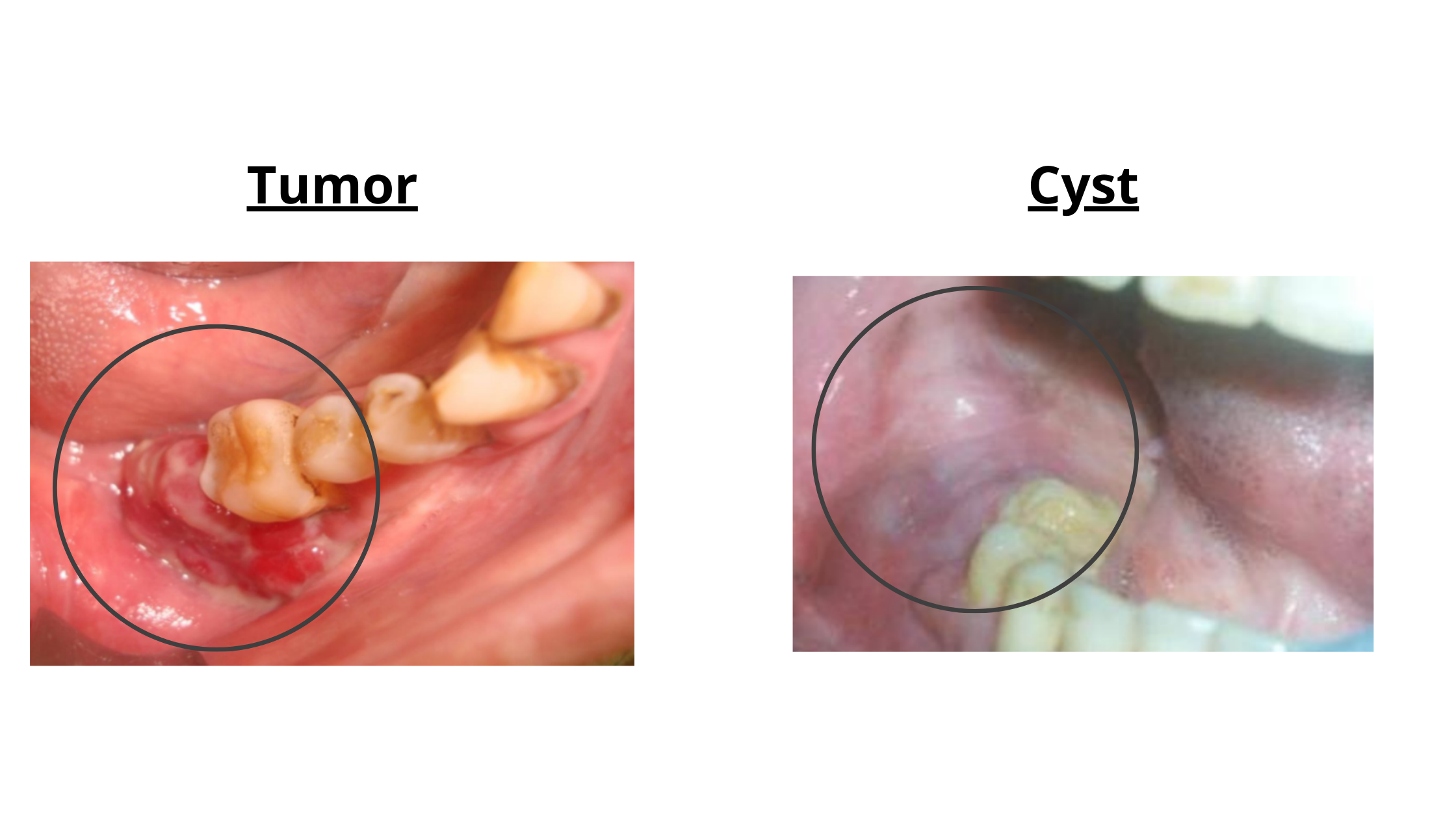 clinical comparison of cysts and tumors around wisdom teeth (a cyst is more regular and well-defined, whereas a tumor is the opposite)