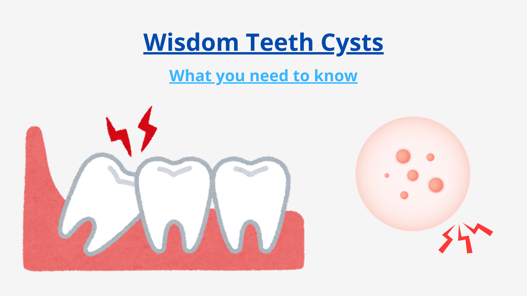 wisdom tooth cyst 