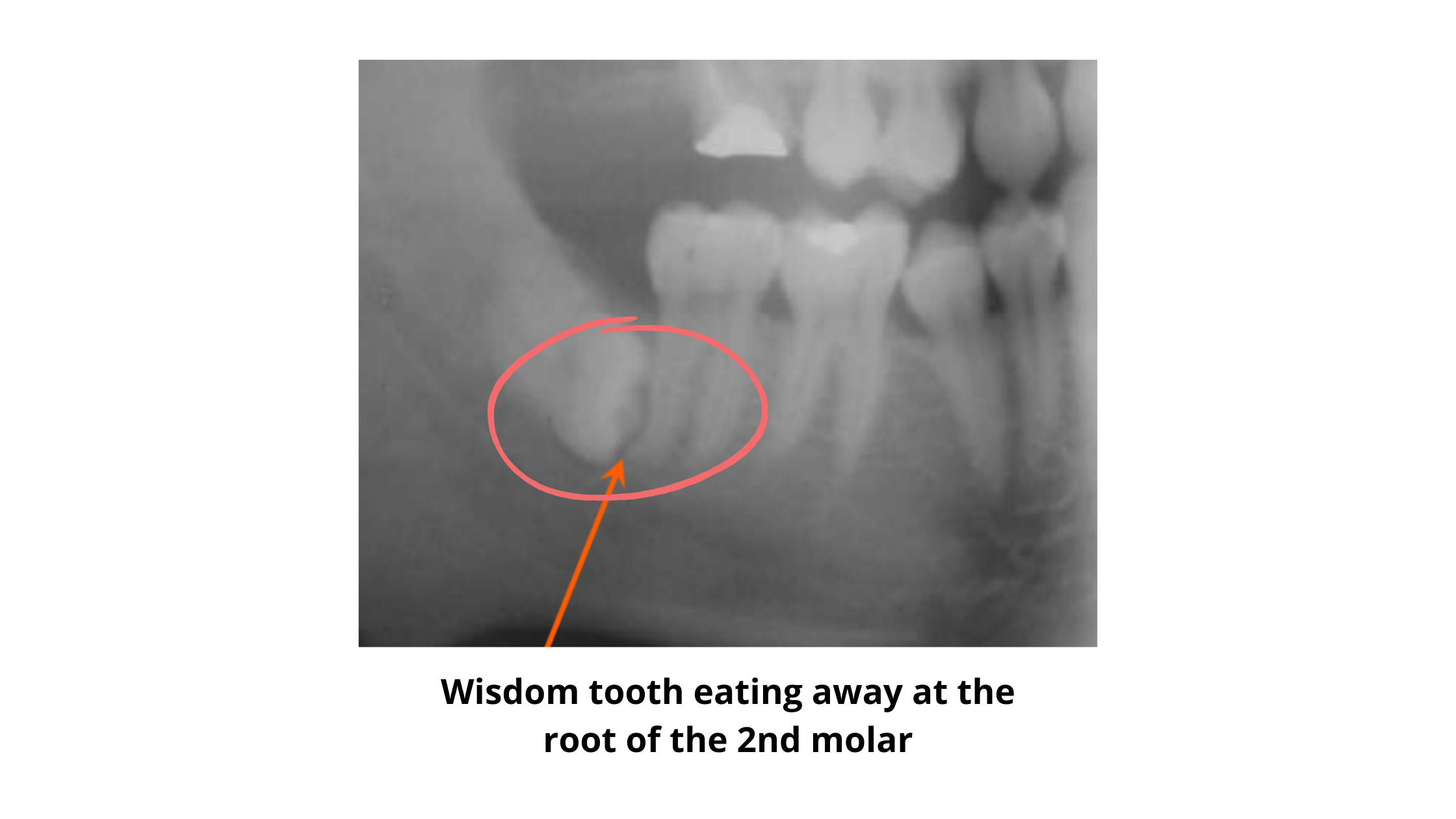 Dental x-rays images showing an impacted lower wisdom tooth eating away at the roots of the second molar