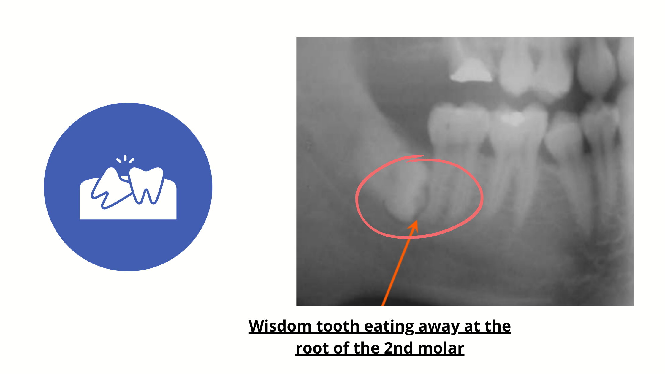 Wisdom tooth growing sideways, damaging the adjacent second molar, with x-rays