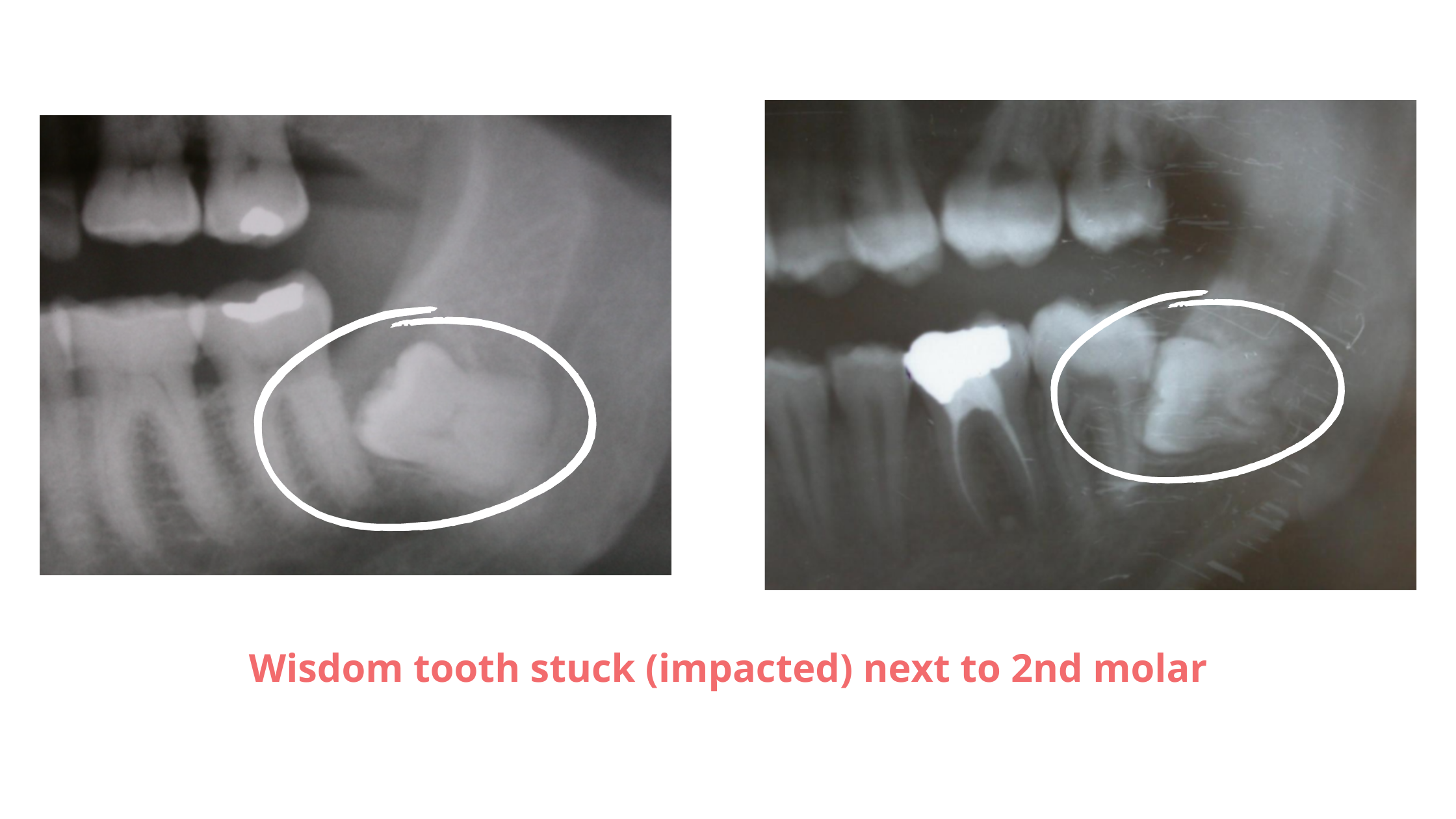 Dental X-rays showing impacted lower wisdom teeth stuck next to the second molars