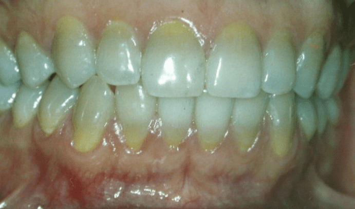 Yellow line along the teeth, near the gum line, caused by tetracycline.